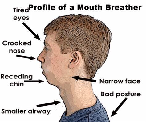 mouthbreather