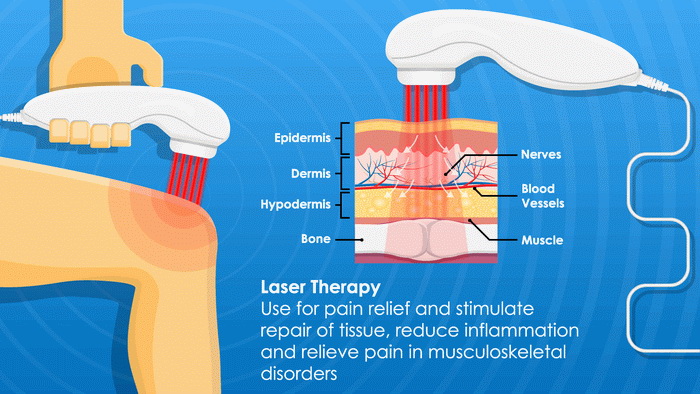 Laser_Therapy_processes dry_needling